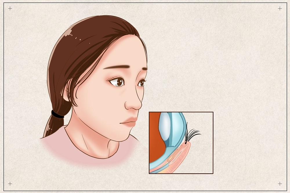 倒睫會自己好嗎？